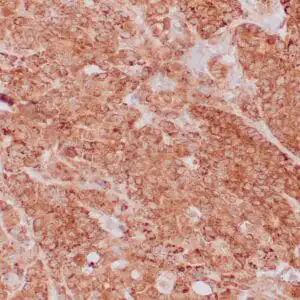 Immunohistochemistry (IHC) : Formalin-fixed, paraffin-embedded human breast carcinoma stained with anti-VEGF antibody using peroxidase-conjugate and DAB chromogen. Note the cell surface and cytoplasmic staining of tumor cells