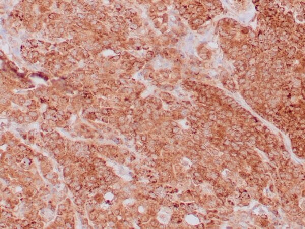 Immunohistochemistry (IHC) : Formalin-fixed, paraffin-embedded human breast carcinoma stained with anti-VEGF antibody using peroxidase-conjugate and DAB chromogen. Note the cell surface and cytoplasmic staining of tumor cells