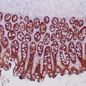 Immunohistochemistry (IHC) : Formalin-fixed, paraffin-embedded human colon stained with anti-villin antibody  using peroxidase-conjugate and DAB chromogen. Note brush border and cytoplasmic staining of epithelial cells