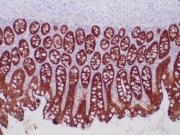 Immunohistochemistry (IHC) : Formalin-fixed, paraffin-embedded human colon stained with anti-villin antibody  using peroxidase-conjugate and DAB chromogen. Note brush border and cytoplasmic staining of epithelial cells