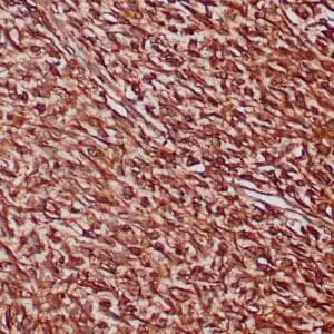 Immunohistochemistry (IHC) : Formalin-fixed, paraffin-embedded human gastrointestinal stromal tumor stained with anti-vimentin antibody using peroxidase-conjugate and DAB chromogen. Note the cytoplasmic staining of tumor cells