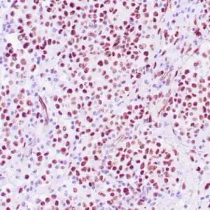 Immunohistochemistry (IHC) : Human ovarian adenocarcinoma stained with anti-WT-1 antibody using peroxidase-conjugate and DAB chromogen. Note the nuclear staining of tumor cells.