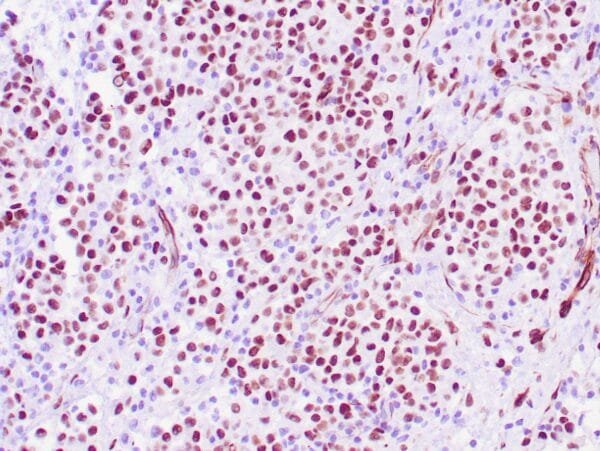 Immunohistochemistry (IHC) : Human ovarian adenocarcinoma stained with anti-WT-1 antibody using peroxidase-conjugate and DAB chromogen. Note the nuclear staining of tumor cells.