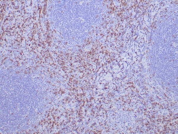 Immunohistochemistry (IHC) : Formalin-Fixed, paraffin-embedded human tonsil stained with anti-ZAP-70 antibody using peroxidase-conjugate and DAB chromogen. Note the cytoplasmic staining of B cells