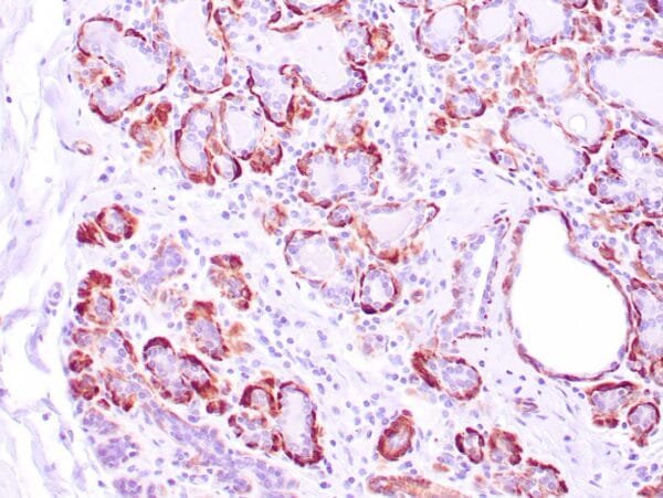 Immunohistochemistry (IHC) : Human breast tissue stained with anti-caldesmon antibody using peroxidase-conjugate and DAB chromogen. Note cytoplasmic staining of myoepithelial cells.