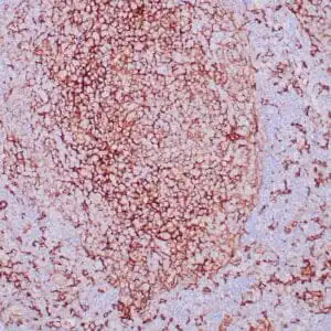 Immunohistochemistry (IHC) : Formalin-fixed, paraffin-embedded human tonsil stained with anti-CD14 antibody using peroxidase-conjugate and DAB chromogen. Note cytoplasmic and membrane staining of Langerhans cells (in follicle) and histiocytes in the perifollicular region
