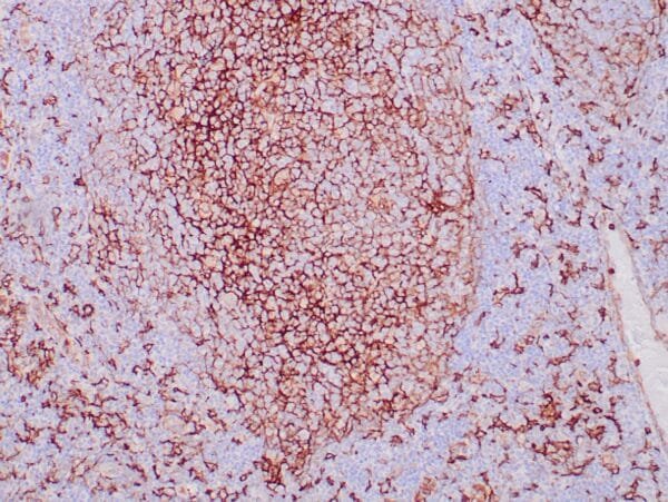 Immunohistochemistry (IHC) : Formalin-fixed, paraffin-embedded human tonsil stained with anti-CD14 antibody using peroxidase-conjugate and DAB chromogen. Note cytoplasmic and membrane staining of Langerhans cells (in follicle) and histiocytes in the perifollicular region