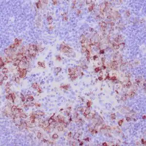 Immunohistochemistry (IHC) : Formalin-fixed, paraffin-embedded human Hodgkin lymphoma stained with anti-CD15 antibody using peroxidase conjugate and DAB chromogen. Note membranous staining of Reed-Sternberg cells