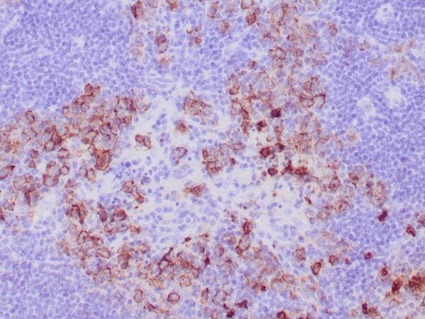 Immunohistochemistry (IHC) : Formalin-fixed, paraffin-embedded human Hodgkin lymphoma stained with anti-CD15 antibody using peroxidase conjugate and DAB chromogen. Note membranous staining of Reed-Sternberg cells