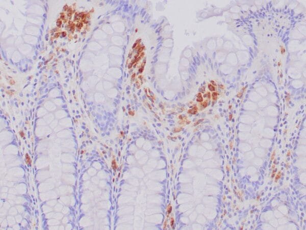 Immunohistochemistry (IHC) : Formalin-fixed, paraffin-embedded human colon stained with anti-CD68 antibody using peroxidase conjugate and DAB chromogen. Note intense cytoplasmic staining of macrophages