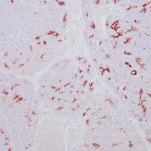 Immunohistochemistry (IHC) : Human ovarian carcinoma stained with anti-Keratin 7 antibody using peroxidase-conjugate and DAB chromogen. Note the cytoplasmic staining of tumor cells.
