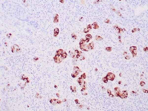 Immunohistochemistry (IHC) : Human breast tissue stained with anti-GCDFP-15 antibody using peroxidase-conjugate and DAB chromogen. Note luminal and cytoplasmic staining of glandular epithelial cells.