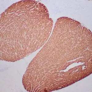 Immunohistochemistry (IHC) : Formalin-fixed, paraffin-embedded human liver stained with anti-glutamine synthetase antibody using peroxidase-conjugate and DAB chromogen. Note the cytoplasmic staining of hepatocytes around a central vein.