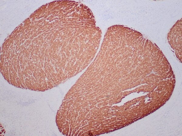 Immunohistochemistry (IHC) : Formalin-fixed, paraffin-embedded human liver stained with anti-glutamine synthetase antibody using peroxidase-conjugate and DAB chromogen. Note the cytoplasmic staining of hepatocytes around a central vein.