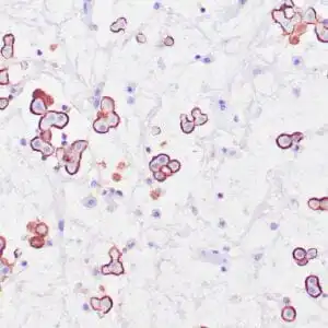 Immunohistochemistry (IHC) : Human mesothelioma stained with anti-HBME1 antibody using peroxidase-conjugate and DAB chromogen. Note membranous staining of tumor cells.