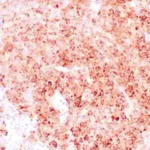 Immunohistochemistry (IHC) : Human granulosa cell tumor stained with anti-Inhibin antibody using peroxidase-conjugate and DAB chromogen. Note the cytoplasmic staining of tumor cells.