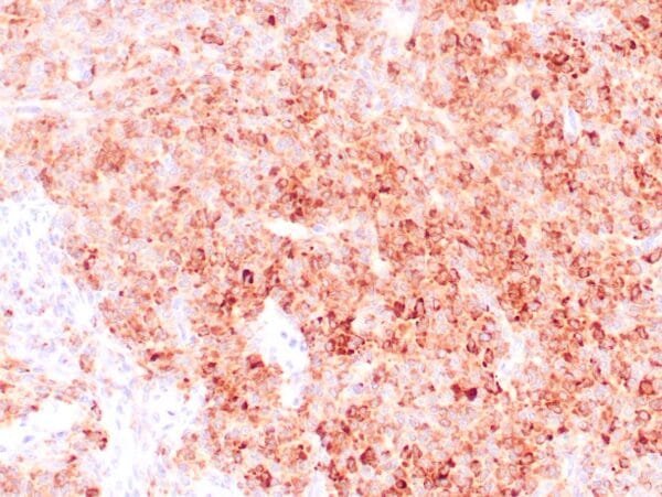 Immunohistochemistry (IHC) : Human granulosa cell tumor stained with anti-Inhibin antibody using peroxidase-conjugate and DAB chromogen. Note the cytoplasmic staining of tumor cells.