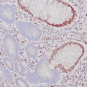 Immunohistochemistry (IHC) : Formalin-fixed, paraffin-embedded human colon adenocarcinoma stained with anti-MSH-2 antibody  using peroxidase-conjugate and DAB chromogen. Note the absence nuclear staining of tumor cells and the presence of nuclear staining of normal mucosa