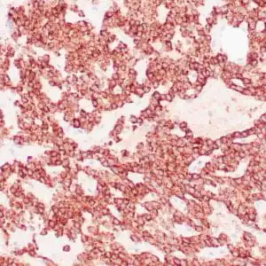 Immunohistochemistry (IHC) : Human parathyroid gland stained with anti-PTH antibody using peroxidase conjugate and DAB chromogen. Note the cytoplasmic staining in glandular cells.