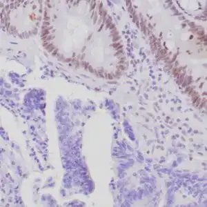 Immunohistochemistry (IHC) : Formalin-fixed, paraffin-embedded human colon adenocarcinoma (Lynch Syndrome) stained with anti-PMS-2 antibody. Note tumor cells are negative whereas normal glands (top) are nuclear positive.