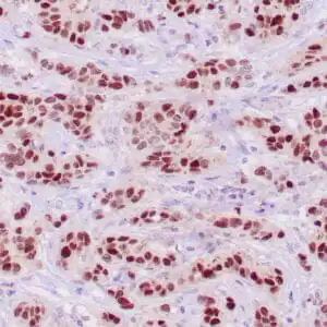 Immunohistochemistry (IHC) : Human breast carcinoma stained with anti-PR antibody using peroxidase-conjugate and DAB chromogen. Note the nuclear staining of tumor cells.
