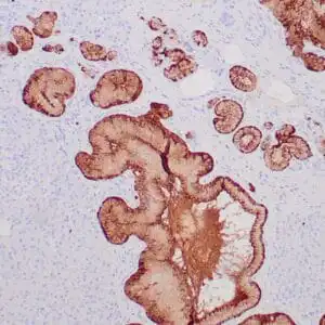 Immunohistochemistry (IHC) : Formalin-fixed, paraffin-embedded human pancreatic ductal carcinoma stained with anti-S100P antibody using peroxidase-conjugate and DAB chromogen. Note cytoplasmic staining of tumor cells