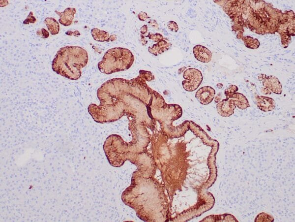 Immunohistochemistry (IHC) : Formalin-fixed, paraffin-embedded human pancreatic ductal carcinoma stained with anti-S100P antibody using peroxidase-conjugate and DAB chromogen. Note cytoplasmic staining of tumor cells