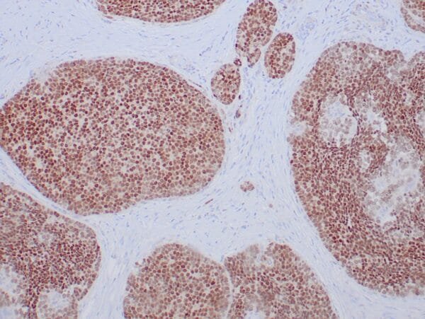 Immunohistochemistry (IHC) : Human adrenal gland stained with anti-SF-1 antibody using peroxidase-conjugate and DAB chromogen. Note nuclear staining of cortical cells.