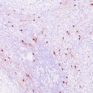 Immunohistochemistry (IHC) : Human tonsil stained with anti-tryptase antibody using peroxidase-conjugate and DAB chromogen. Note the cytoplasmic staining of scattered mast cells.