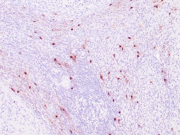 Immunohistochemistry (IHC) : Human tonsil stained with anti-tryptase antibody using peroxidase-conjugate and DAB chromogen. Note the cytoplasmic staining of scattered mast cells.