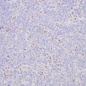 Immunohistochemistry (IHC) : Formalin-fixed, paraffin-embedded human glioblastoma stained with anti-ATRX antibody using peroxidase-conjugate and DAB chromogen. Note no nuclear staining of neoplastic cells (ARTX mutation)