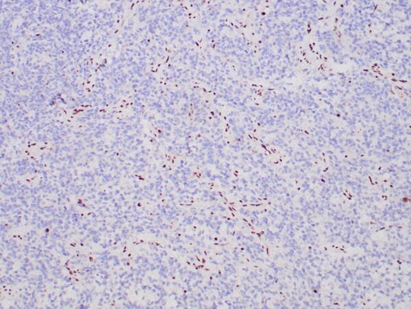 Immunohistochemistry (IHC) : Formalin-fixed, paraffin-embedded human glioblastoma stained with anti-ATRX antibody using peroxidase-conjugate and DAB chromogen. Note no nuclear staining of neoplastic cells (ARTX mutation)