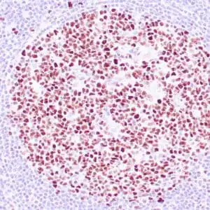 Immunohistochemistry (IHC) : Human reactive lymph node stained with anti-BCL-6 antibody using peroxidase-conjugate and DAB chromogen. Note nuclear staining of follicular center B-cells.