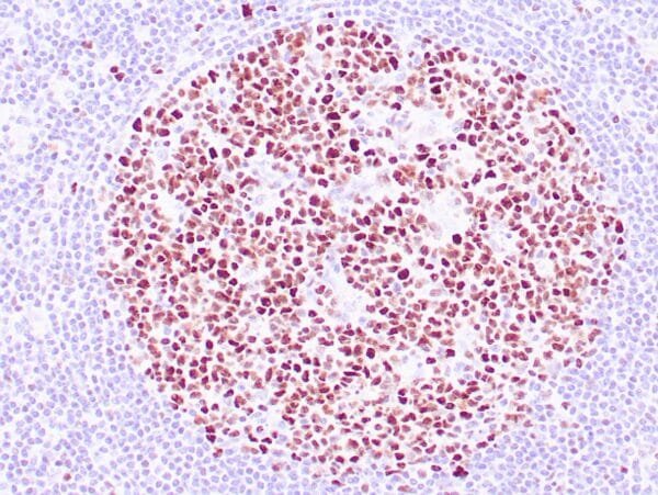 Immunohistochemistry (IHC) : Human reactive lymph node stained with anti-BCL-6 antibody using peroxidase-conjugate and DAB chromogen. Note nuclear staining of follicular center B-cells.