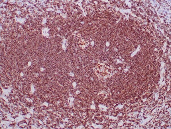 Immunohistochemistry (IHC) : Formalin-fixed, paraffin-embedded human lymph node stained with anti-CD20 antibody using peroxidase-conjugate and DAB chromogen. Note cell surface staining of B-cells.