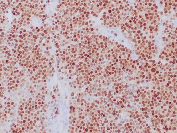 Immunohistochemistry (IHC) : Formalin-fixed, paraffin-embedded human IgA myeloma stained with anti-MUM1 antibody using peroxidase-conjugate and DAB chromogen. Note the nuclear staining in tumor cells