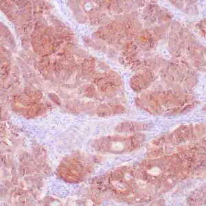 Immunohistochemistry (IHC) : Human colon adenocarcinoma stained with MOC-31 antibody using peroxidase-conjugate and DAB chromogen. Note the membranous staining of tumor cells.