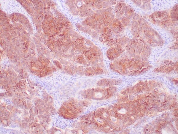 Immunohistochemistry (IHC) : Human colon adenocarcinoma stained with MOC-31 antibody using peroxidase-conjugate and DAB chromogen. Note the membranous staining of tumor cells.